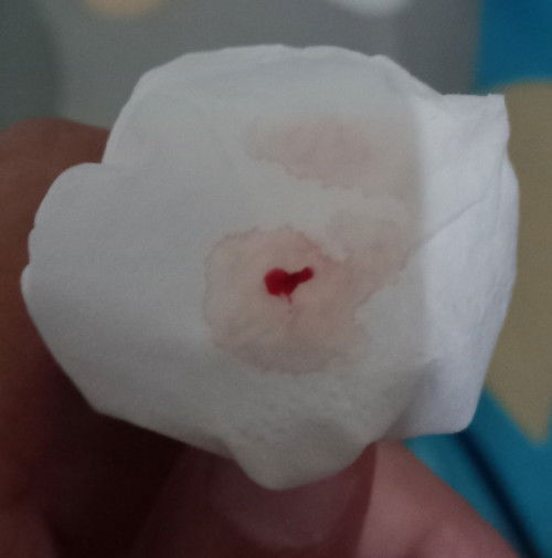 Muncul darah saat pipis