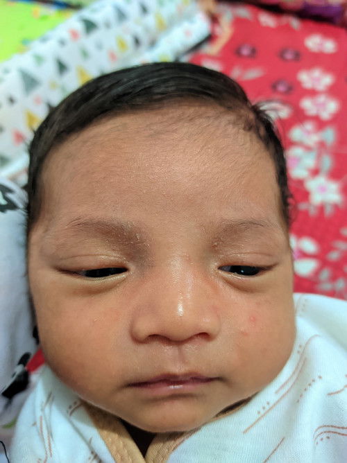 Obat bruntusab di muka