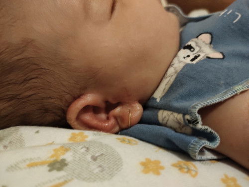 Leher dan Telinga Bayi Lecet