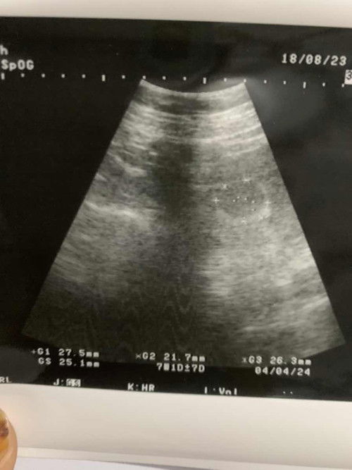 Hamil 7minggu Baru Terlihat Kantung ?