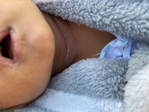 ลูกน้อยคอเปื่อยทำไงดีคะ