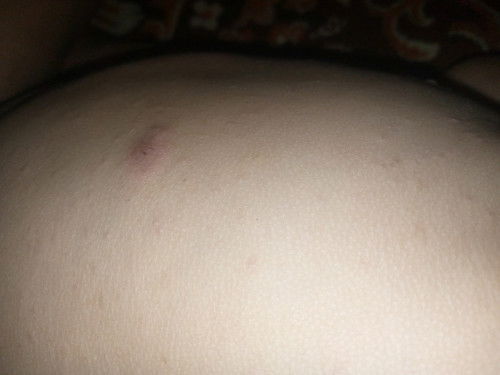 Muncul bentol² gatal