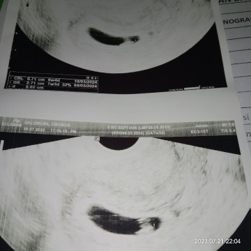 INI KANTUNG KE HAMILAN ATAU BUKAN