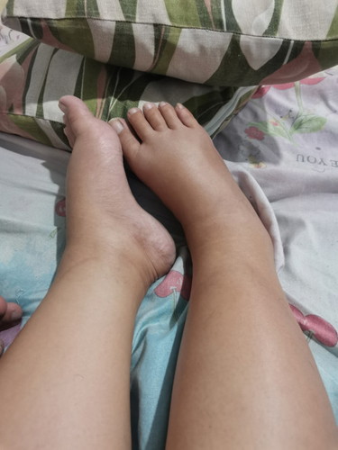 sobrang pagmamanas