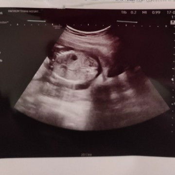 19 สัปดาห์ 2 วัน