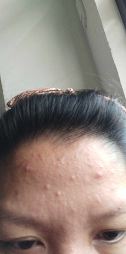 hi mga momsh, ask kulang anong magandang remedy or gamitin sa mga buntis 17weeks preggy?