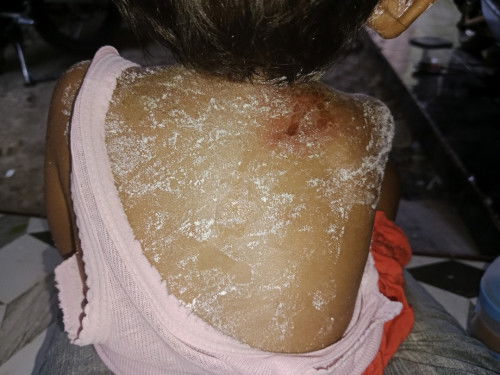 Ketumpahan sayur panas