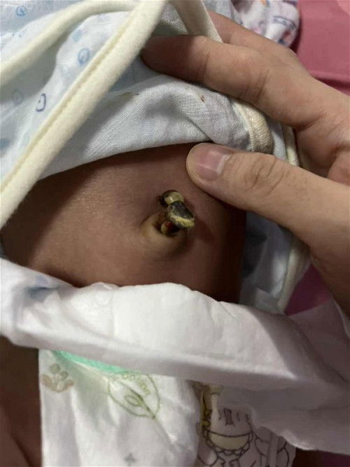 สอบถามค่ะ สะดือแบบนี้เป็นไรไหมค่ะ น้องได้16วันค่ะ #ลูกคนแรก