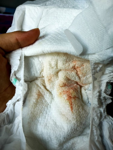 Bayi new born keluar darah saat pipis, kenapa ya?