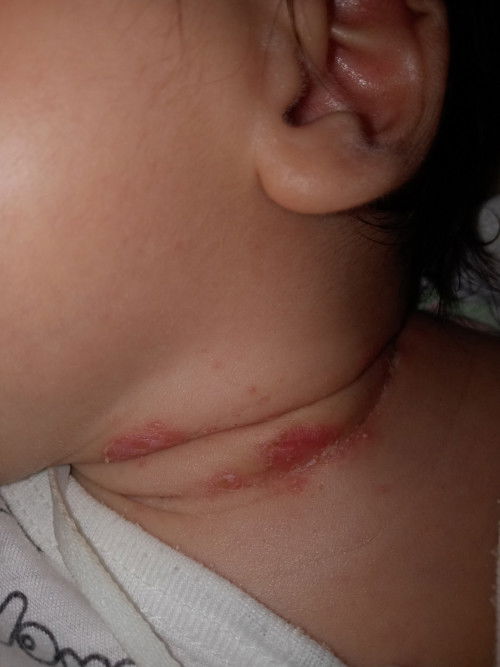 น้องอายุ25วัน  คอน้องเป็นตุ่มแผลแบบนี้เป็นอะไรคะ  ทำยังไงถึงจะหาย