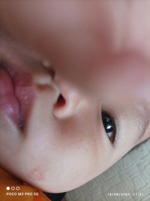 ada yang pernah mengalami seperti ini? sdh saya kasih cream muka,tp tetap ga ada perubahan.