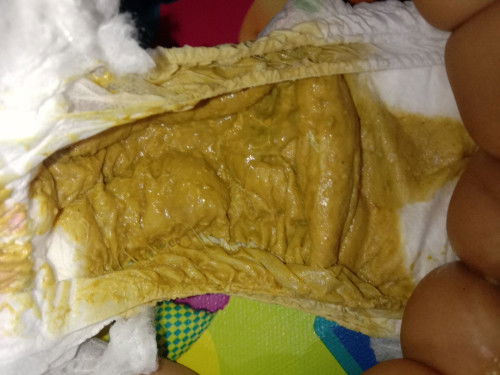 Bun maaf mau tanya dong anak saya pup nya gini kaya ada lendirnya dia 6 bln itu normal gak ya?