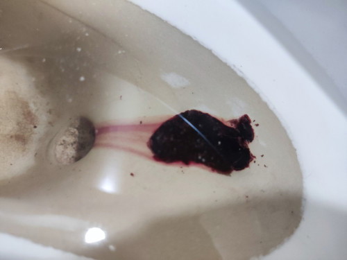 Blighted Ovum, 1 week spotting