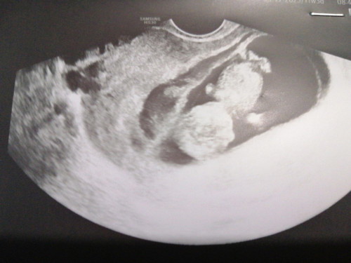 2 weeks bedrest due to sub hemo, Still may spotting po. Sino nka experience nito mga momsh?