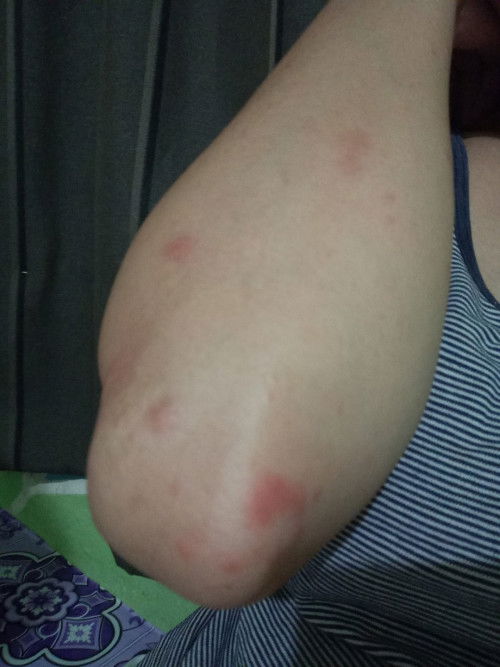 Gatal selepas suntikan perancang depo-provera