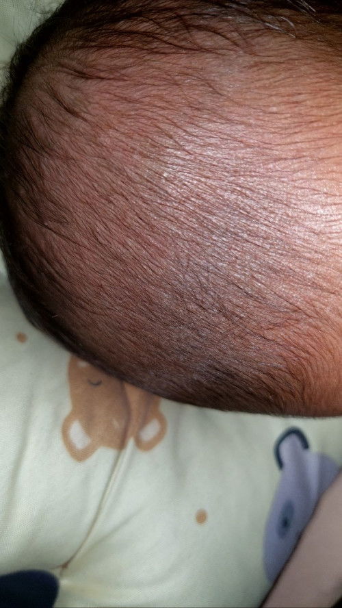 Anak 1,5 bln kulit kepalanya pada putih