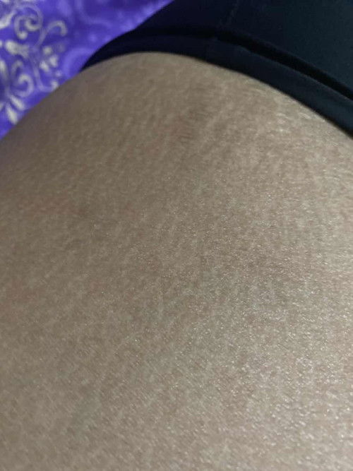 perut kering bersisik ada yg sama ga?