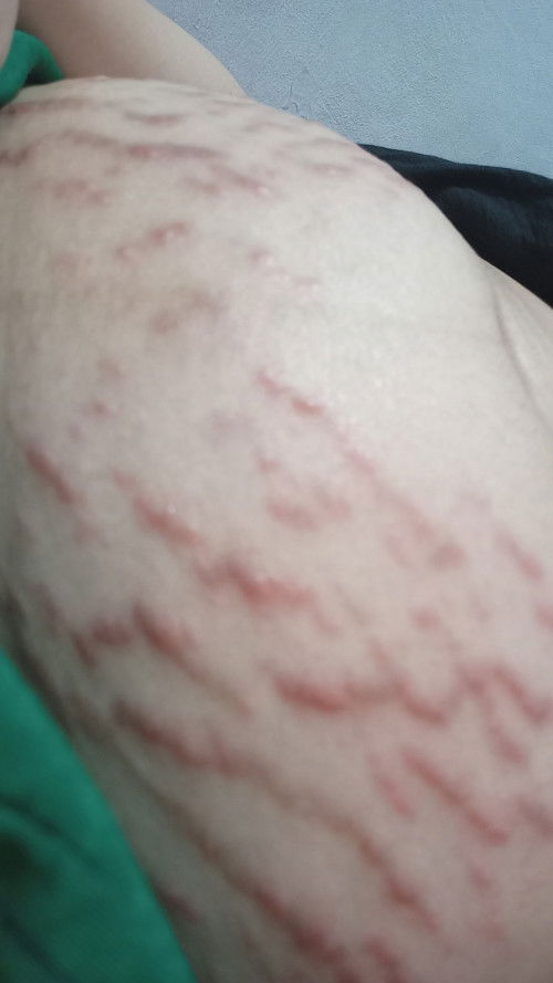 maaf ya bun gambarnya aga aga. bun ada ga di sini yang stretch mark menonjol kaya gini. minta saran