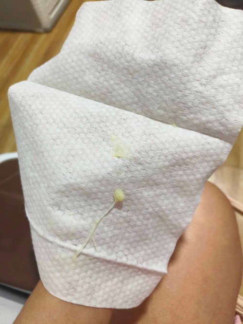 Yellow Discharge at 37 weeks and 4 days