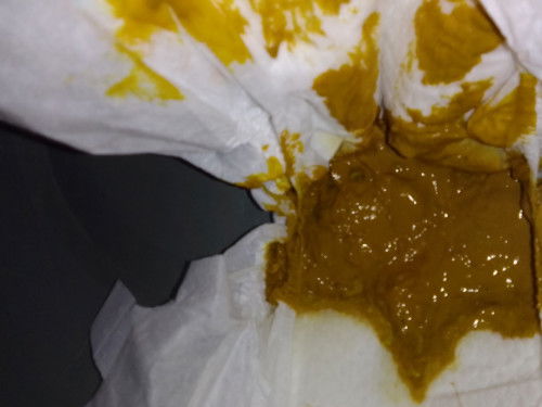 Alhamdulillah anak sya sdc BAB Bun..tapi tekstur  dan warna x Kya gini  normal kah Bund.?