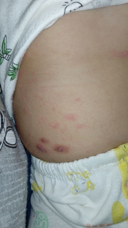 Bruntusan pada badan