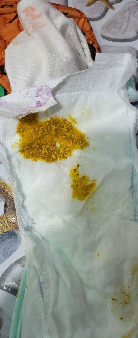 Bé 18 ngày tuổi đi phân có hạt