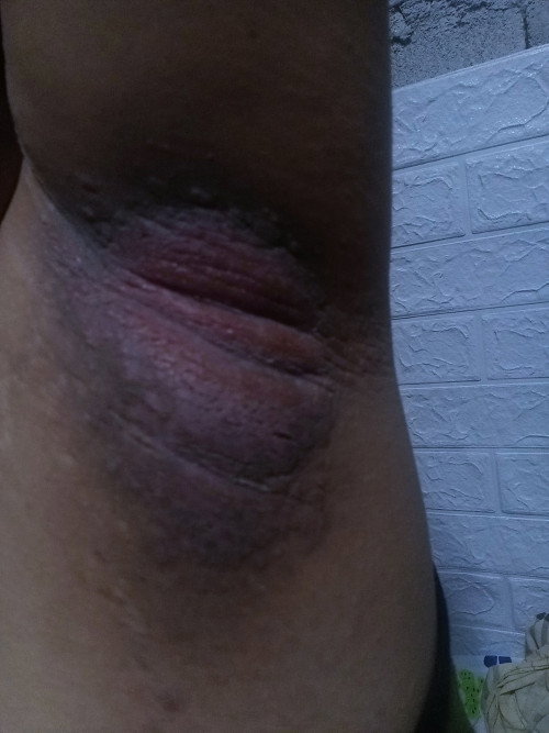 Rashes sa kili kili