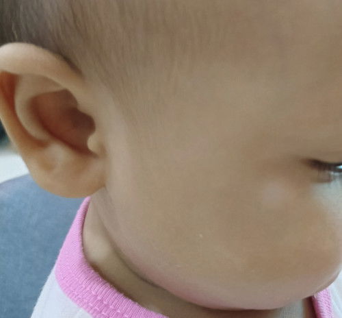 Tompok putih. Panau ke ni?