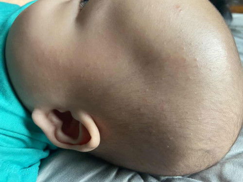 Mom anaknya ada yang pernah bintik2 gini ga di kepala dan di pipi ?