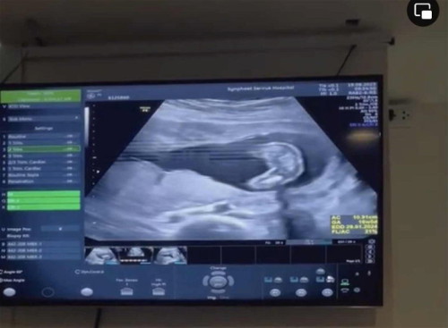 ท้อง 17W3Dแม่ๆรู้เพศยังคะ