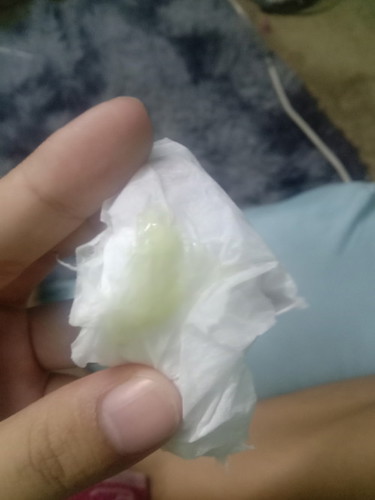 มูกใสหรือตกขาว