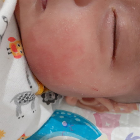 Pipi bayi merah merah