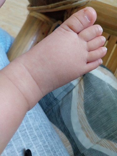 baby swollen foot