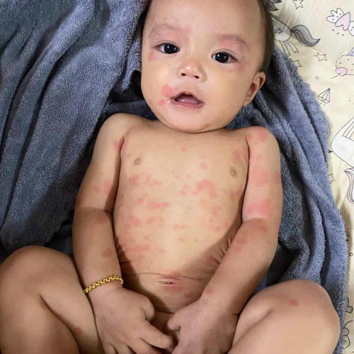 น้องผื่นขึ้นเต็มตัว