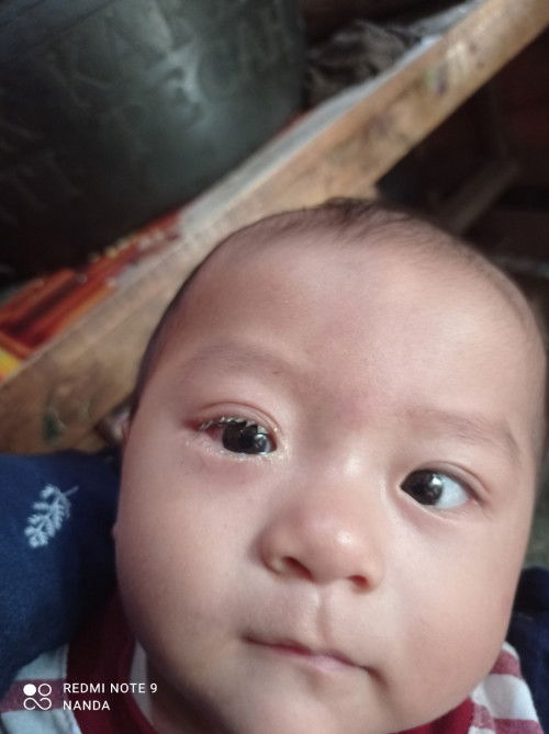 Bayi 6 bulan sakit mata
