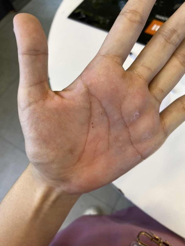 คันหน้ามือและหน้าเท้าเป็นอะไรมั้ยคะ