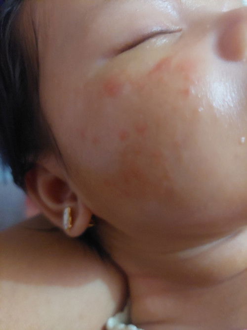 Bund boleh minta solusi nya ga untuk gatal bayi sprti ini