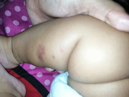 Bekas gigitan apa ya