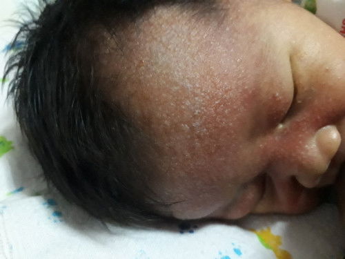 อายุ7วัน มีเม็ดเล็กๆเต็มหน้าผาก หนังตา จมูก ใตตา ตั้งแต่คลอดออกมาเลยค่ะ