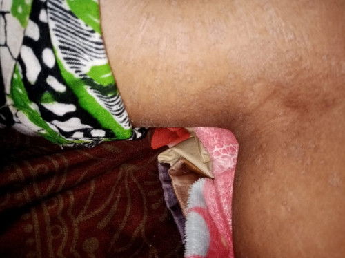 Bintik hitam seperti panu