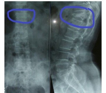 Benturan saat hamil dibulan2 pertama