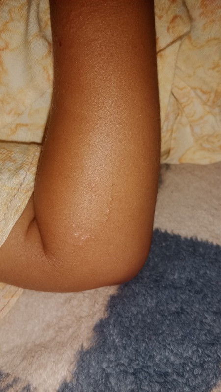 Bintik bintik dan tidak gatal pada anak