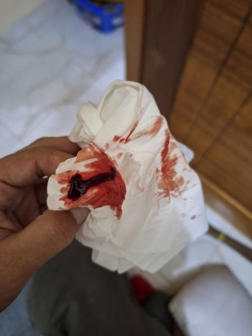 Uk 39w 1d keluar lendir bercampur darah