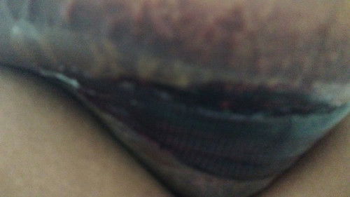 SC dengan Riwayat Preeklam, Sampai Buka Lagi Jahitan