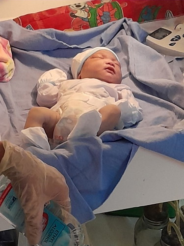 Namumuo at kulay dilaw na pupu ni baby