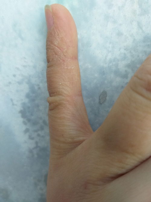 Từ lúc e bầu tới nay tay e cứ bị ngứa gãi thì khô nứt v là bị sao ạ, có mom nào biết chỉ e vs