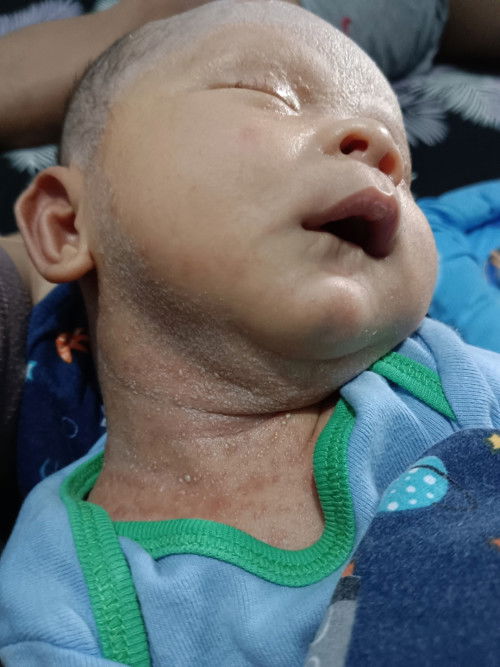 Permasalahan kulit baby NB