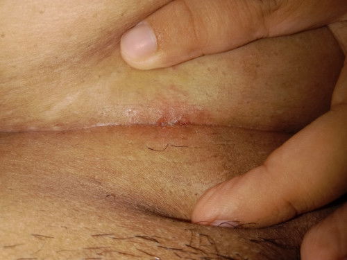 แผลปริไหมคะแบบนี้