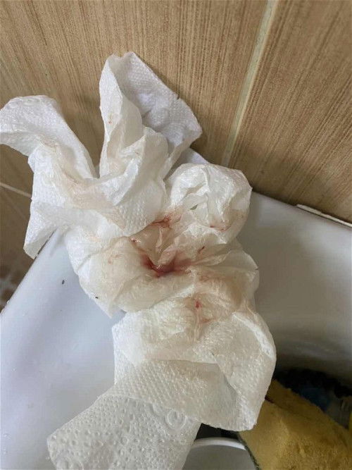 38+6 W. มีมูกเลือดออก และตอนนี้กลายเป็นสีน้ำตาล