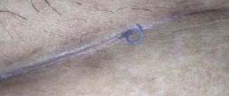 Pasca operasi Caesar